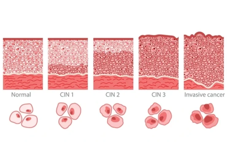 CIN Treatment (Cervical Intraepithelial Neoplasia)