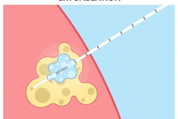 Cryoablation