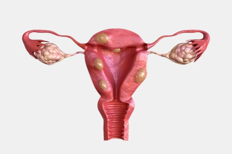 Fibroids