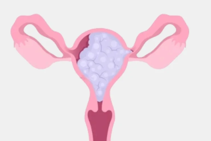 Gestational Trophoblastic Neoplasia (GTN)