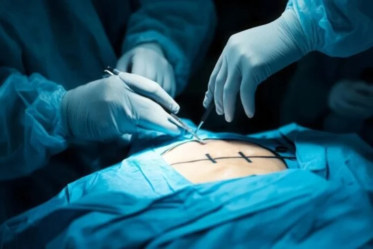 Laparoscopic Surgery